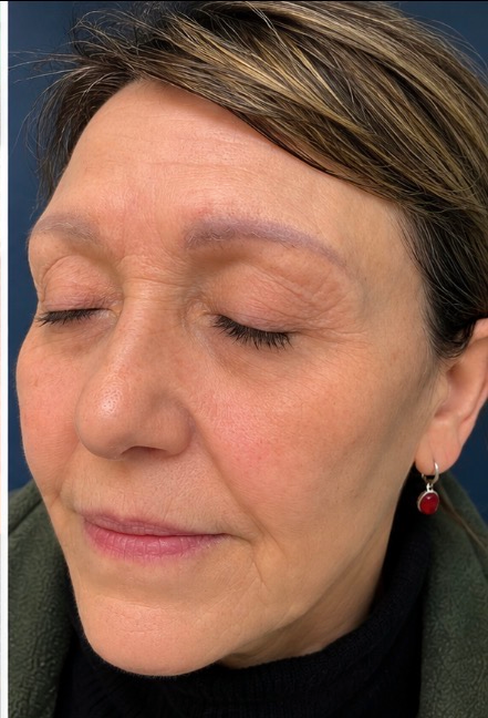 Fibroblast Treatment after result