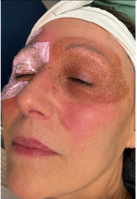 Fibroblast Treatment before result