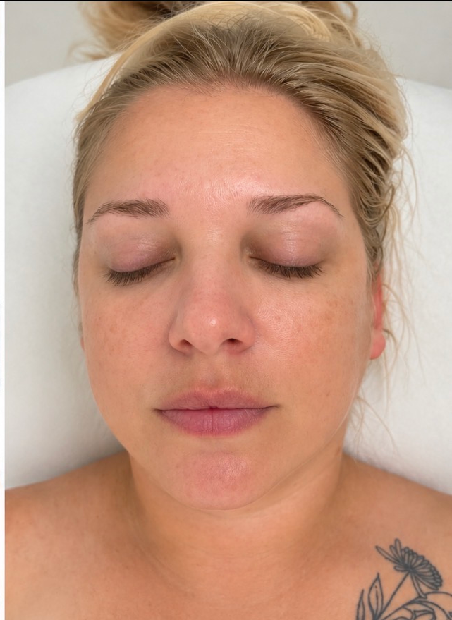 HIFU Treatment after result