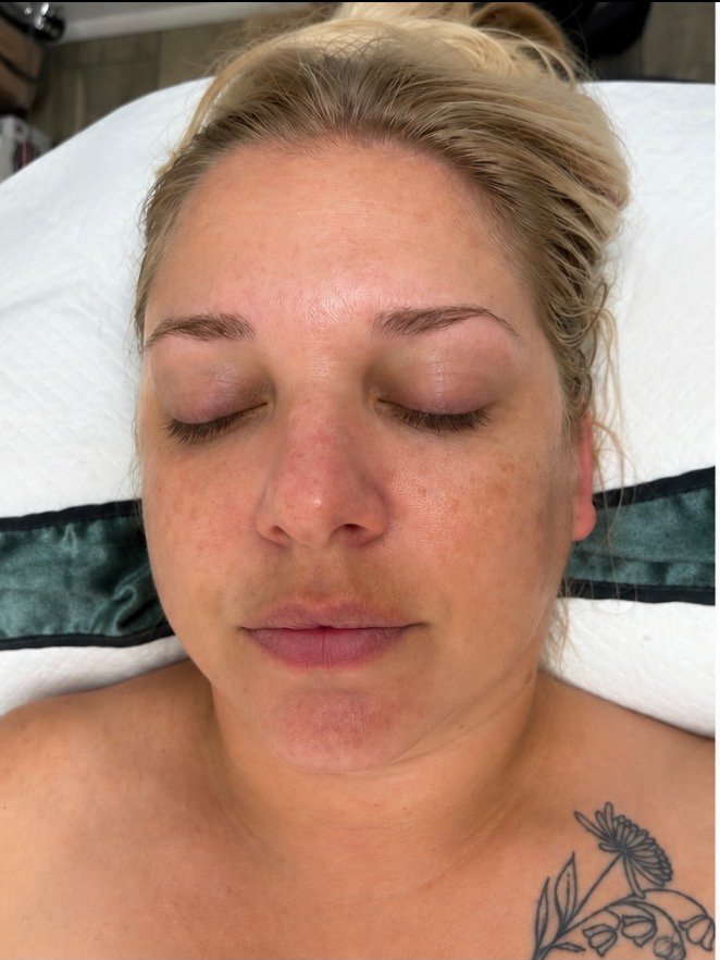 HIFU Treatment before result
