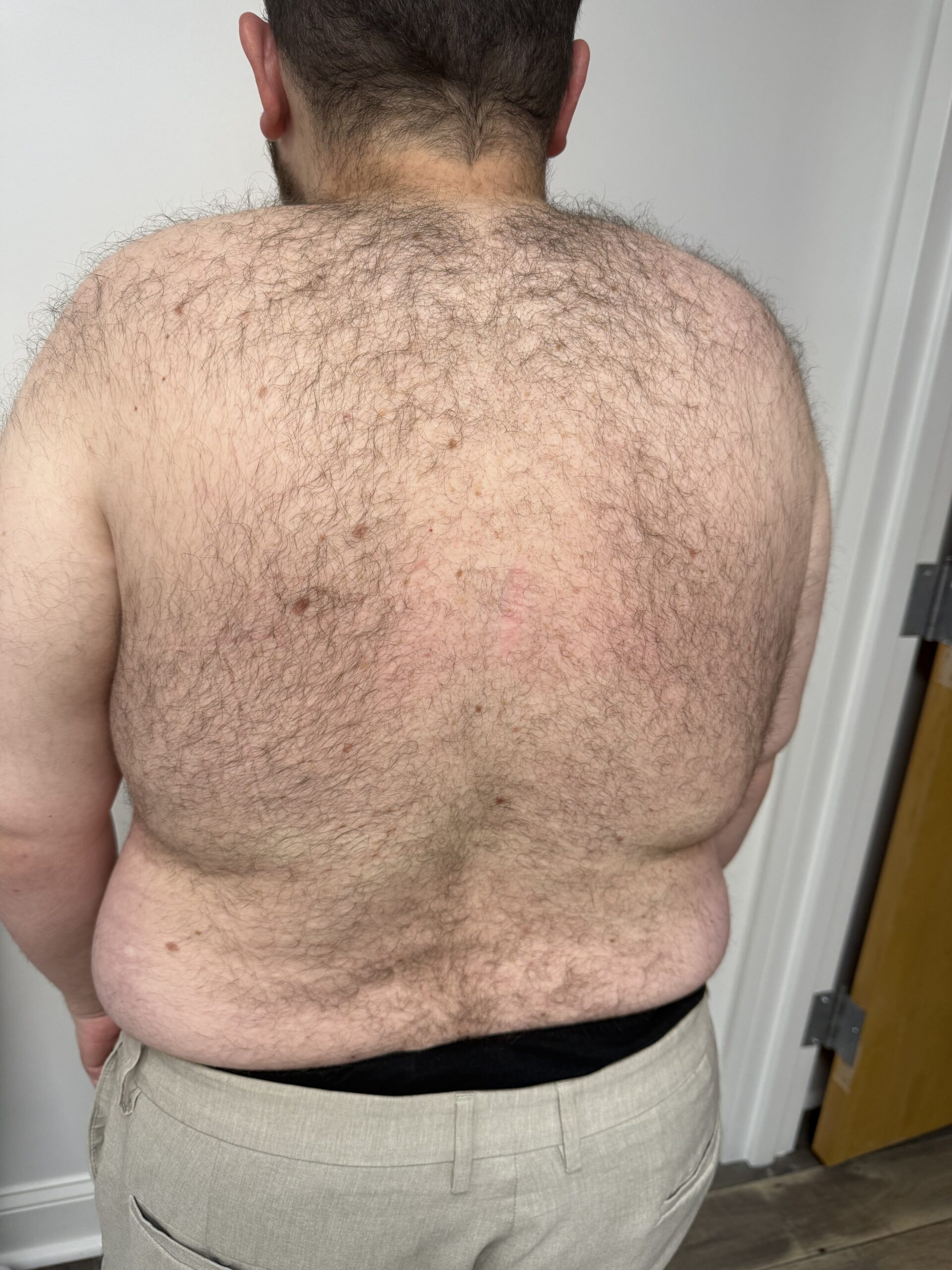 Laser Hair Removal before result
