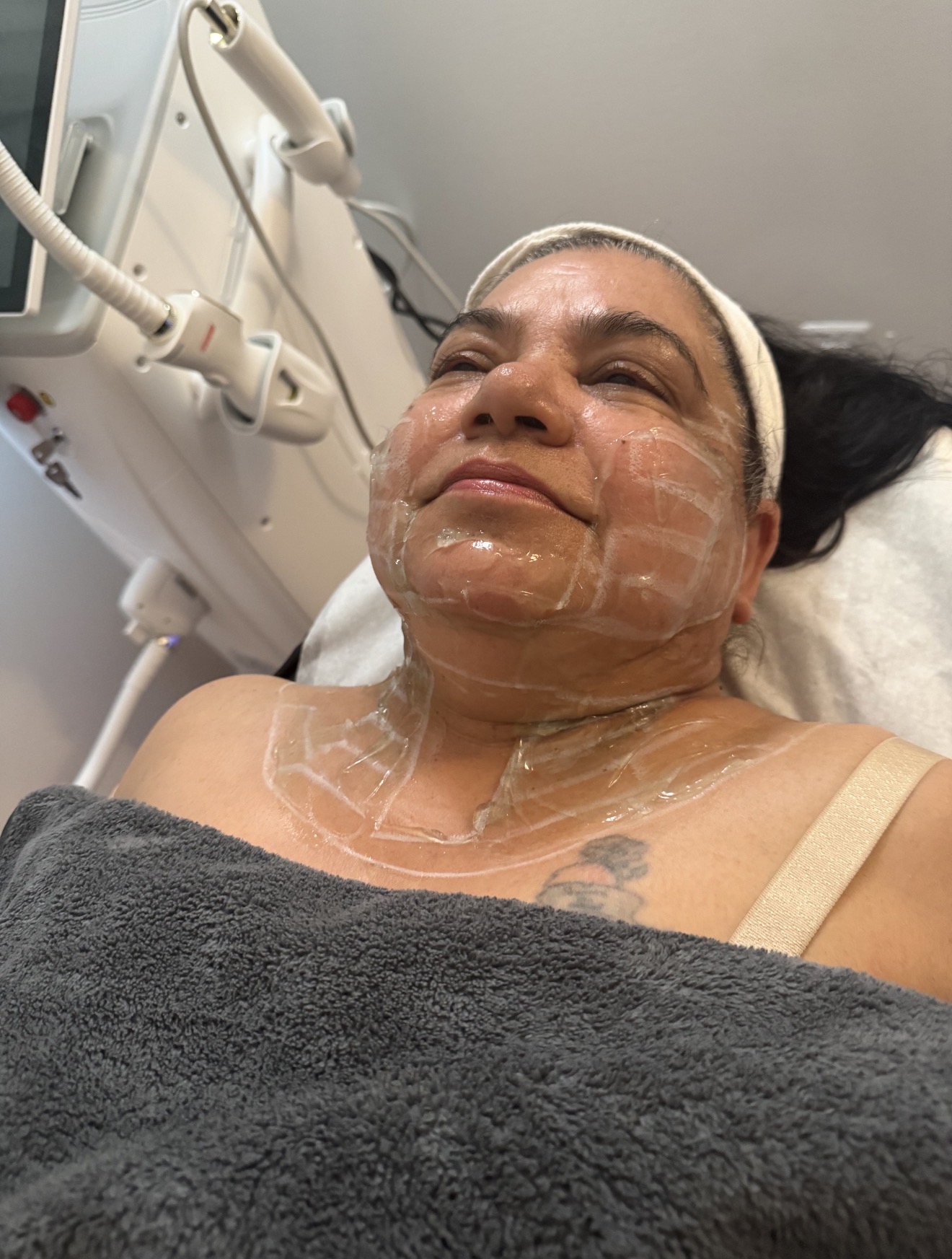 HIFU Treatment  before result