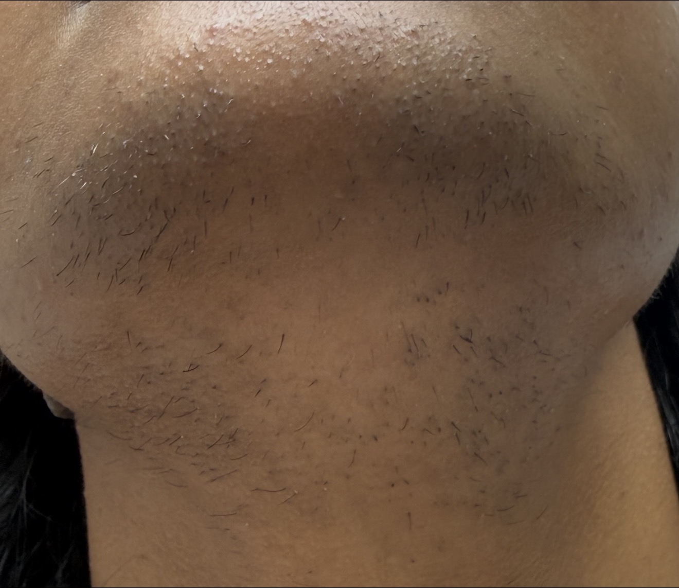 Laser Hair Removal  before result