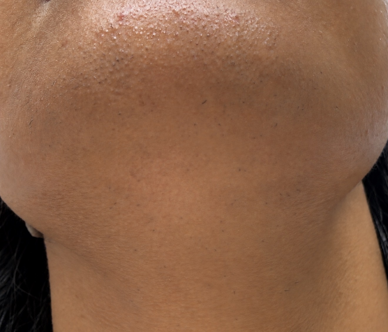 Laser Hair Removal  after result