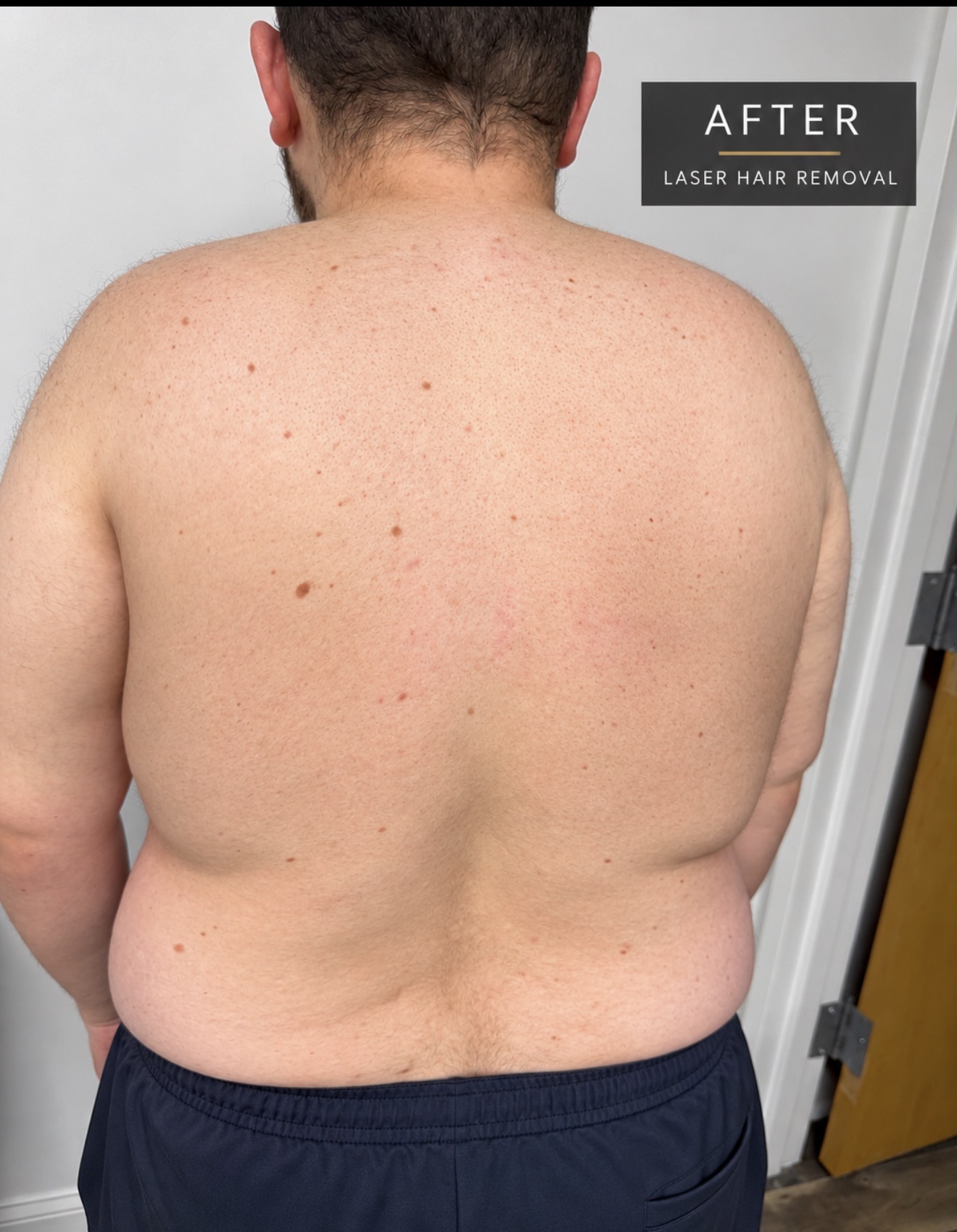 Laser Hair Removal after result