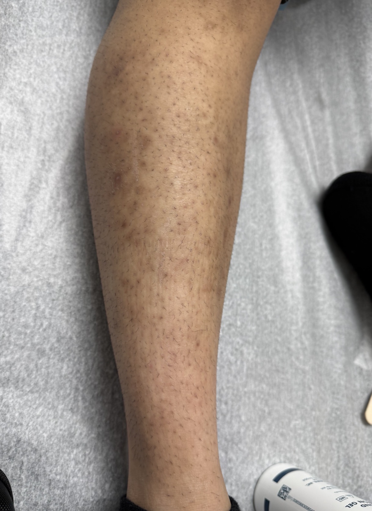 Laser Hair Removal before result