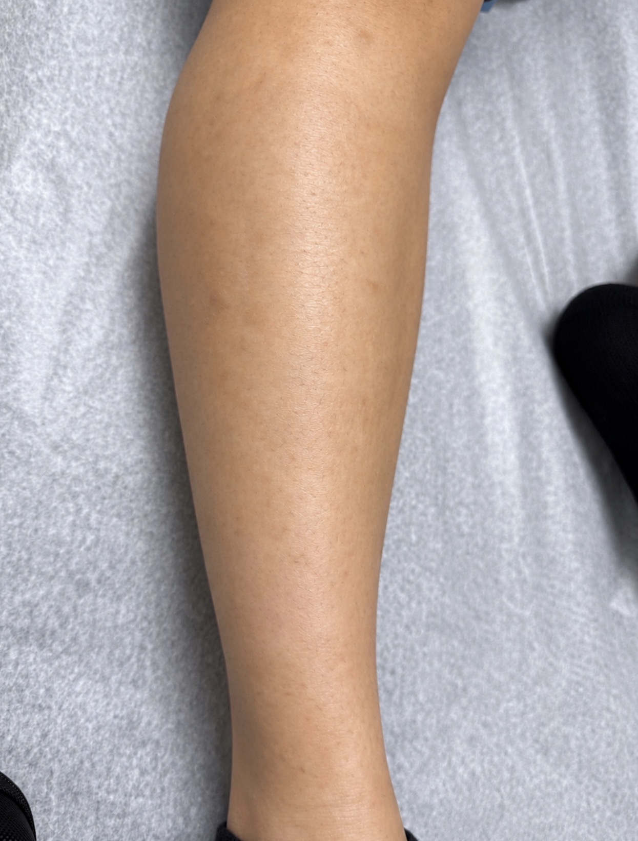 Laser Hair Removal after result