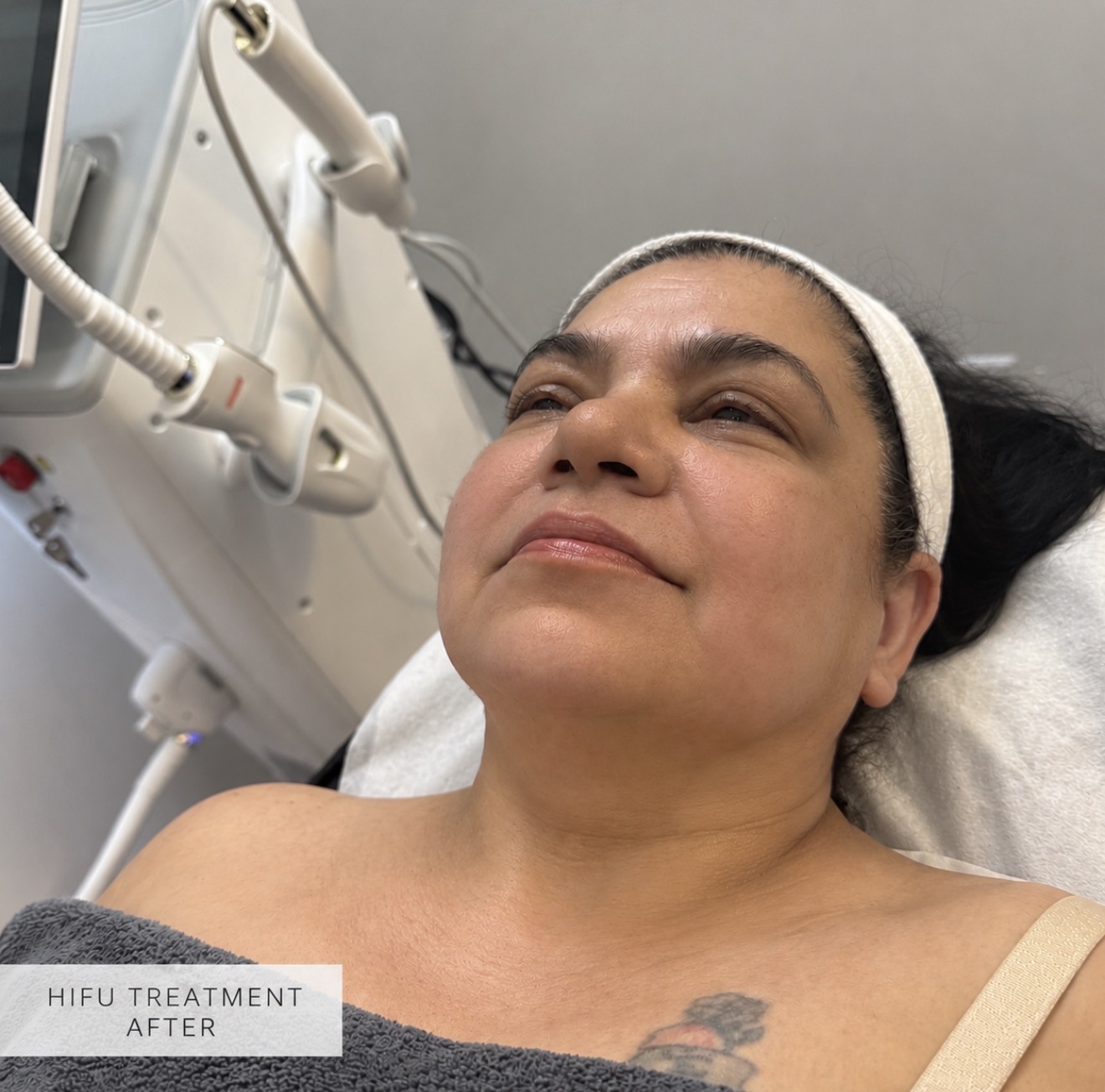 HIFU Treatment  after result